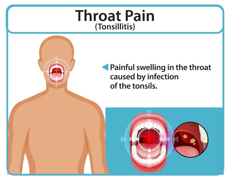throat infection ka ilaj by DesiExpert.com