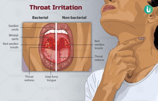throat infection ka ilaj by DesiExpert.com